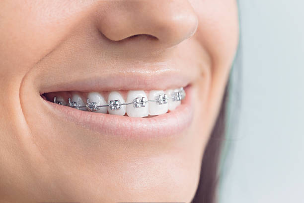 Best Invisalign and Clear Aligners  in Lanham, MD